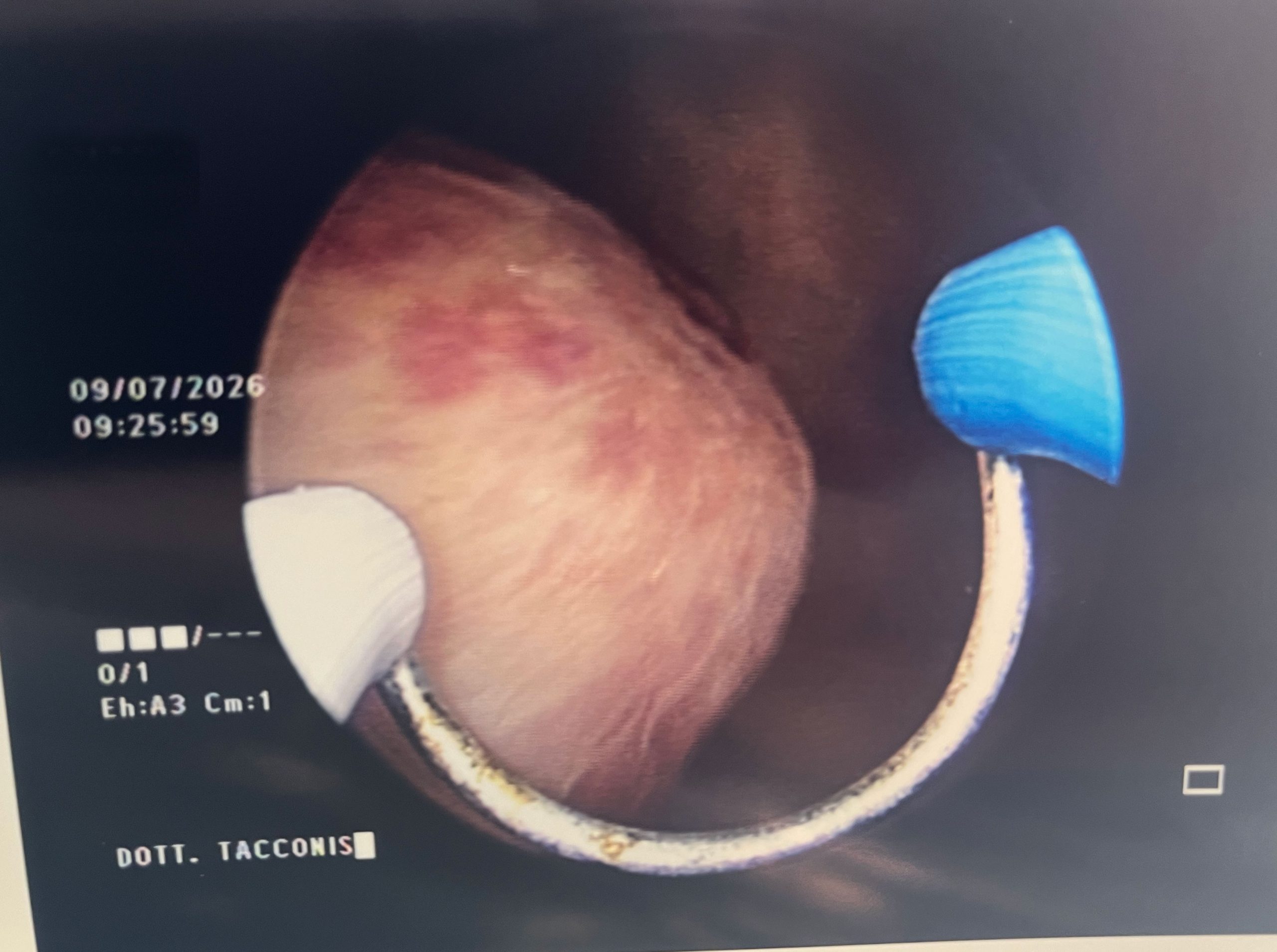 resettore isteroscopico per resezione dei polipi uterini
